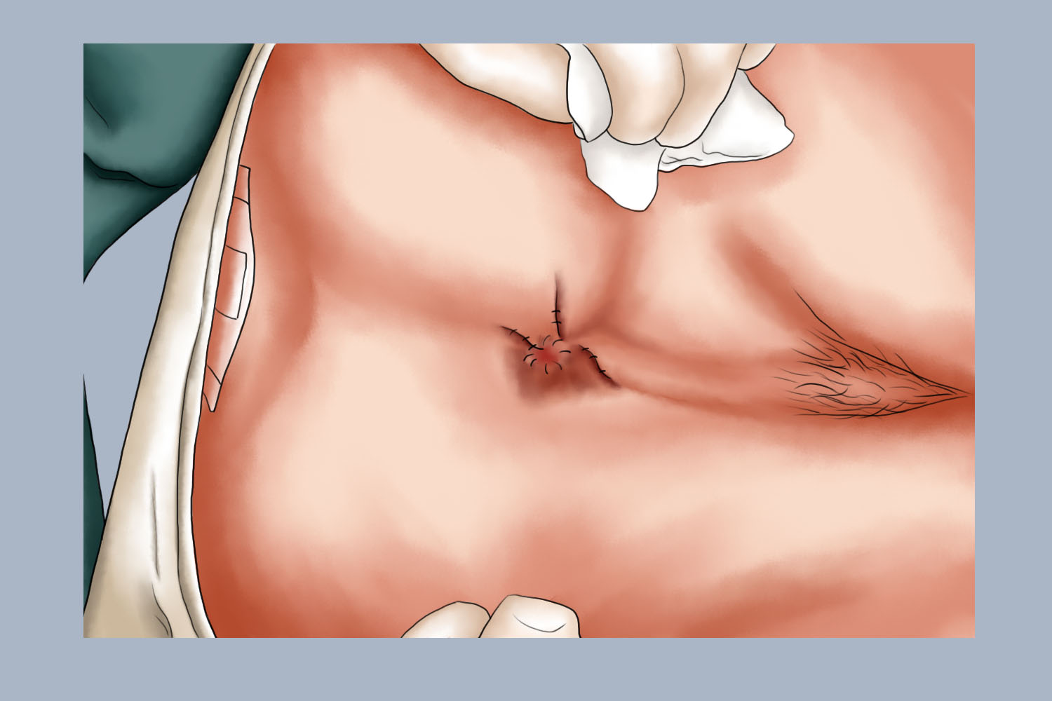 肛裂手术刀口图