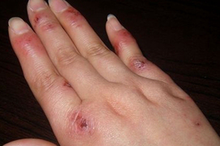 冻疮手部结痂图