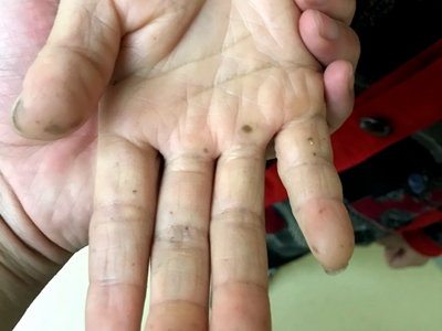 色素沉着息肉综合征手指上有很多黑斑图.jpg