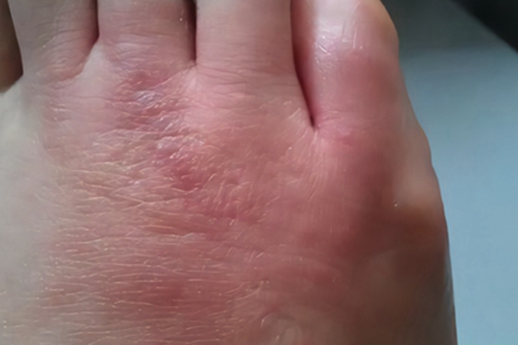 蚁蜇伤脚上大面积红斑图 蚁蜇伤脚上大面积红斑图