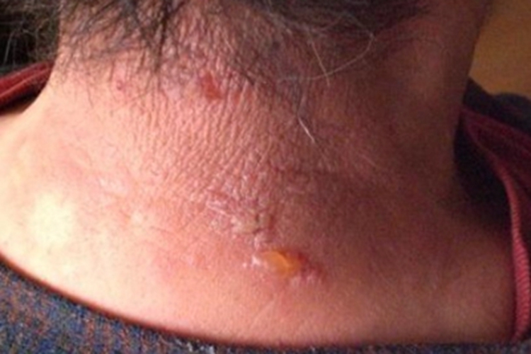刺毛虫皮炎后颈症状图 刺毛虫皮炎后颈症状图