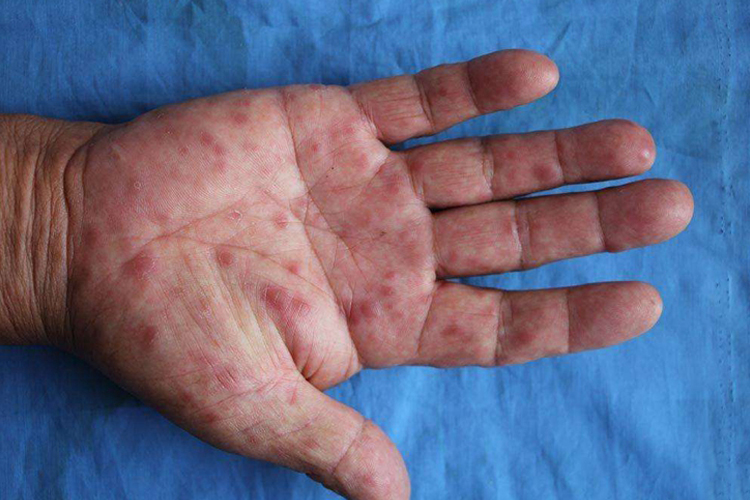 斑疹性梅毒褐红色斑图