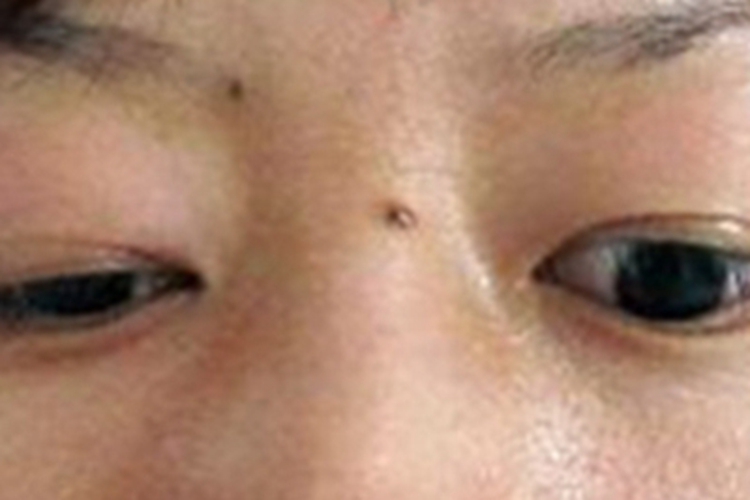 单纯性甲状腺肿眼部变形图