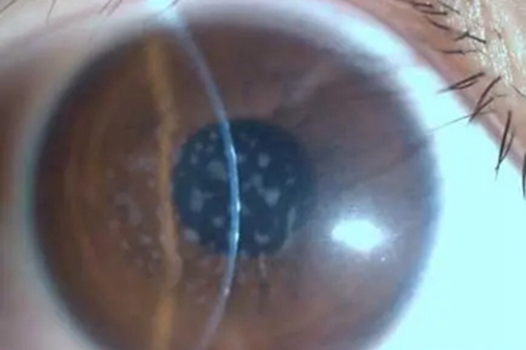 神经营养性角膜炎角膜水肿图 神经营养性角膜炎角膜水肿图