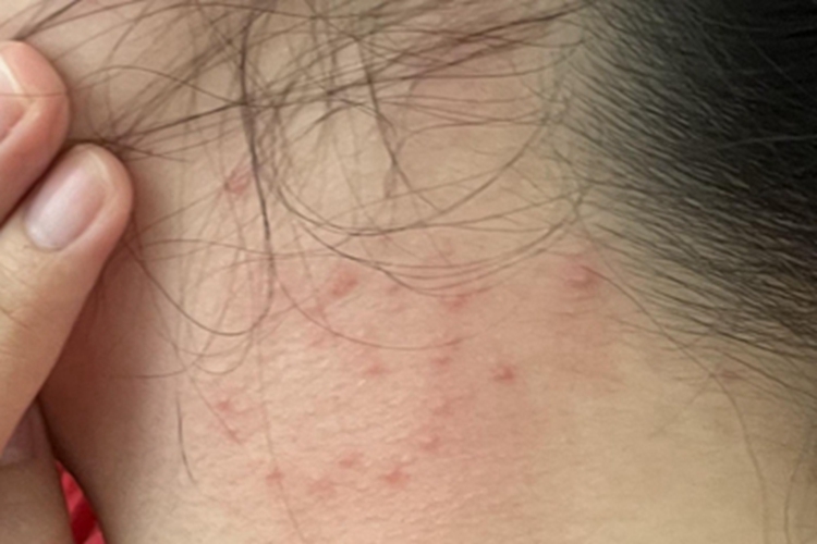 丘疹性荨麻疹颈部症状图