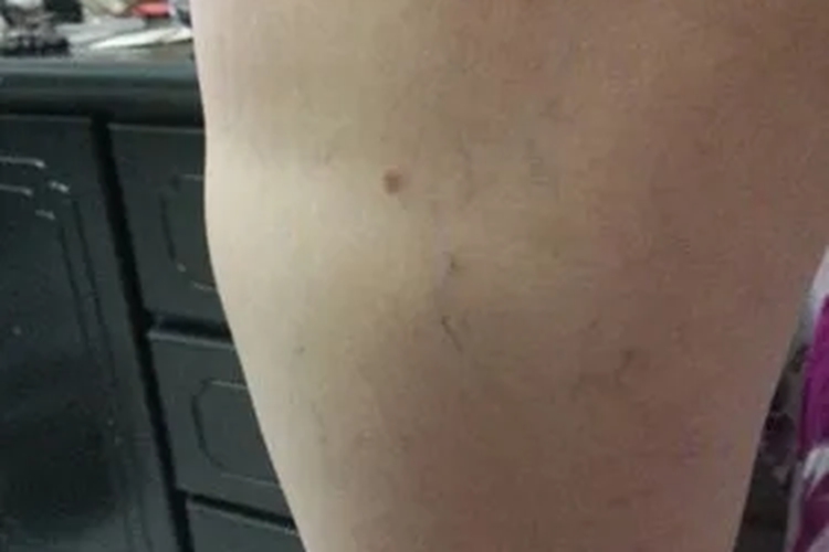 大腿肌肉萎缩图