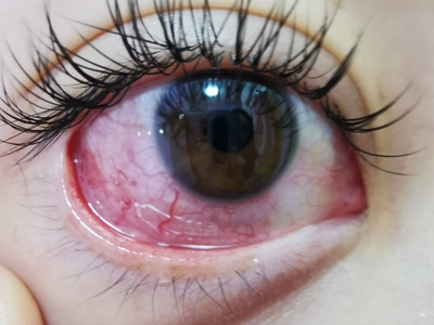 速发型过敏性结膜炎的症状和图片 - 有来医生
