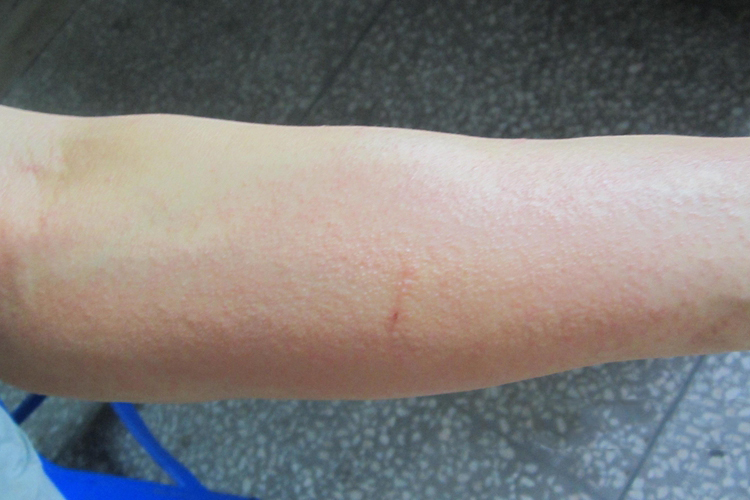 亚急性接触性皮炎图 亚急性接触性皮炎图