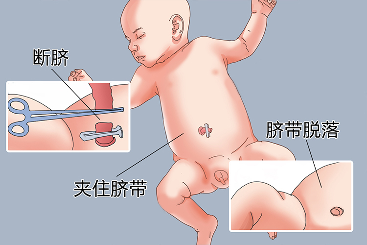 新生儿脐带脱落后脐部图