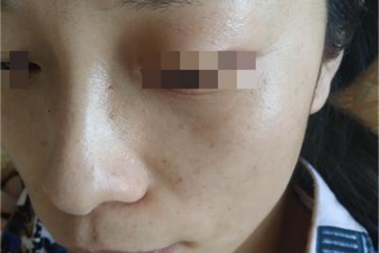 雀斑面颊上长有褐色的斑点图 雀斑面颊上长有褐色的斑点图