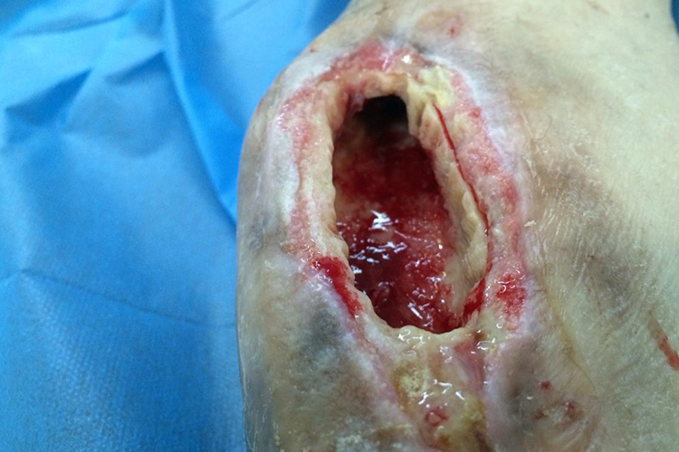 骨髓炎流脓图 骨髓炎流脓图