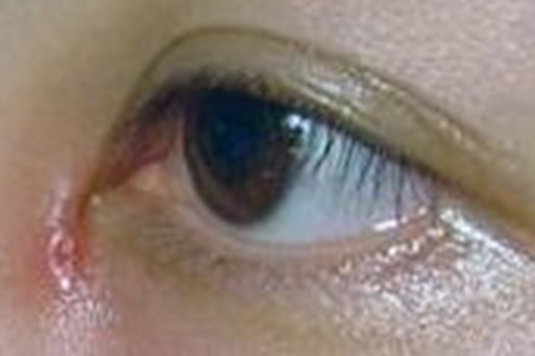 儿童眦部睑缘炎图