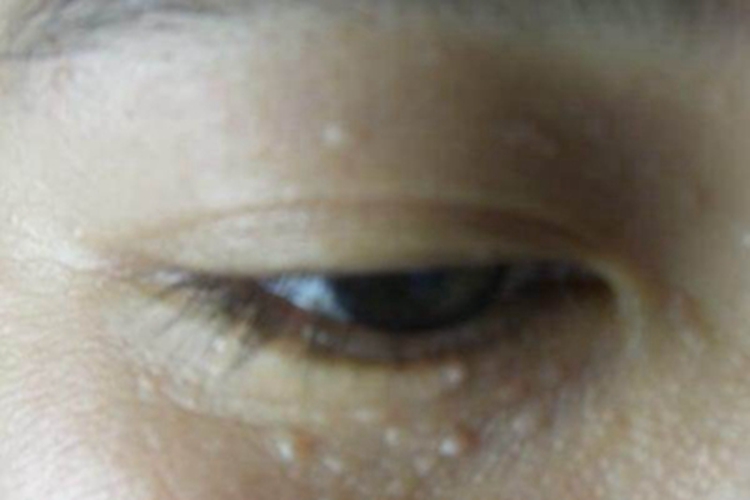 汗腺瘤眼周半圆形丘疹图