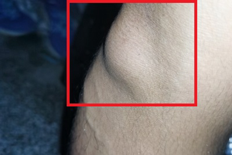 皮下脂肪瘤小腿包块图 皮下脂肪瘤小腿包块图