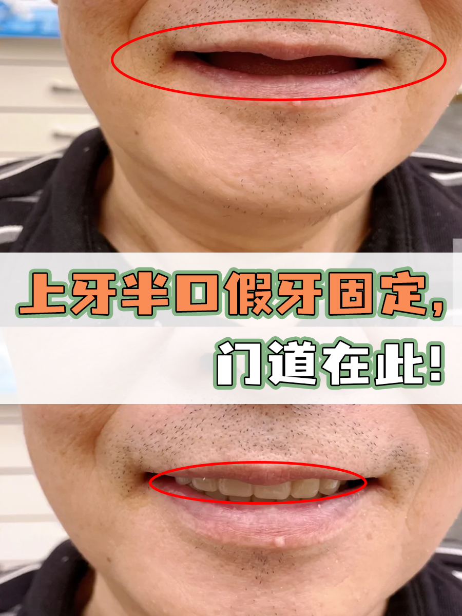 上牙半口假牙固定,门道在此!