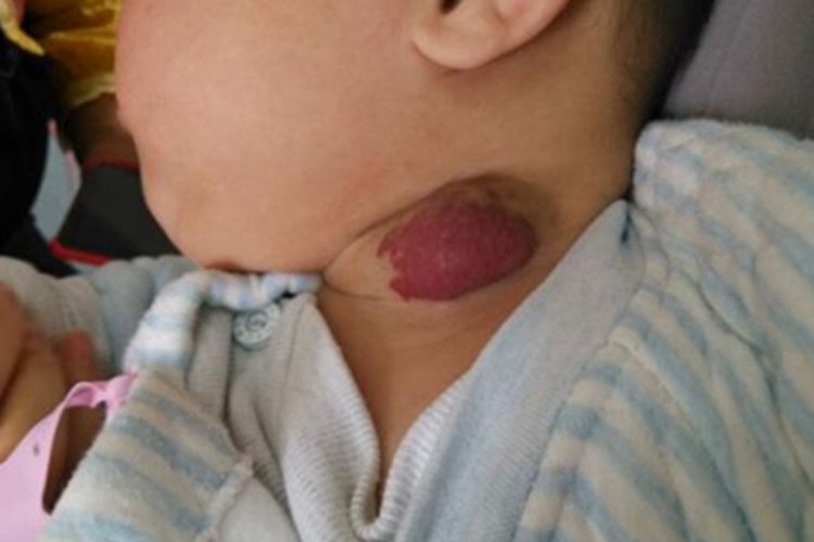 血管瘤侧颈肿块图