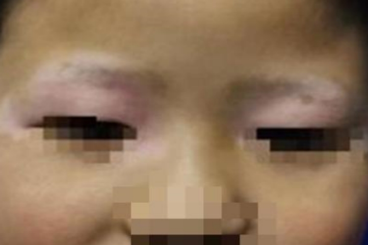面肢端型白癜风眼睑症状图