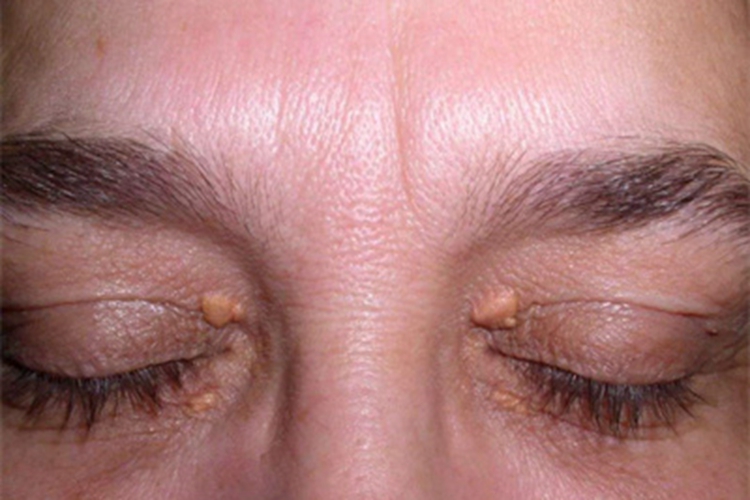 扁平黄瘤眼角有黄疙瘩图