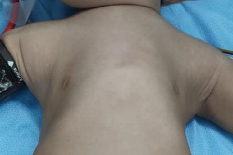 长期哮喘胸骨突出图