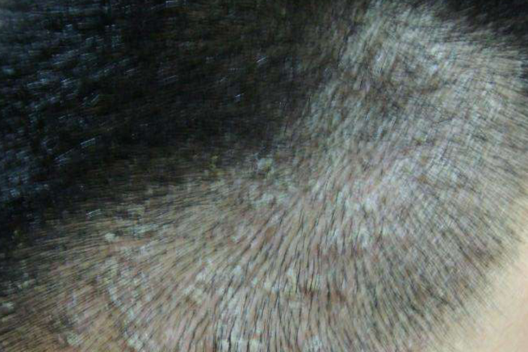 后脑勺头皮头癣图