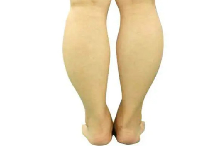 小腿肌肉粗大图