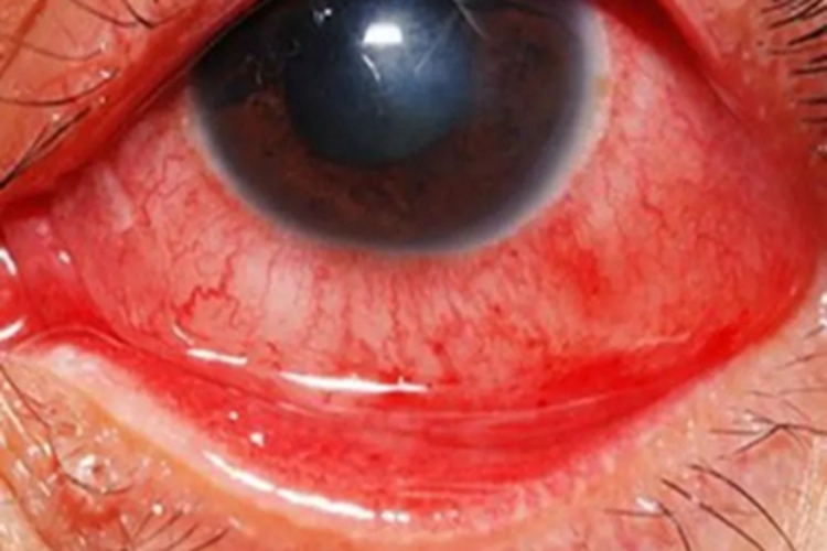 腺病毒性角结膜炎眼球水肿图