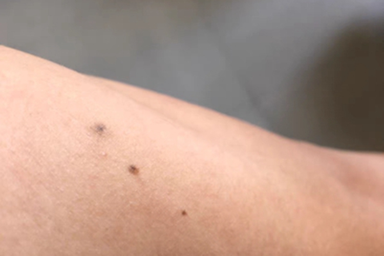 皮内痣胳膊黑斑图 皮内痣胳膊黑斑图