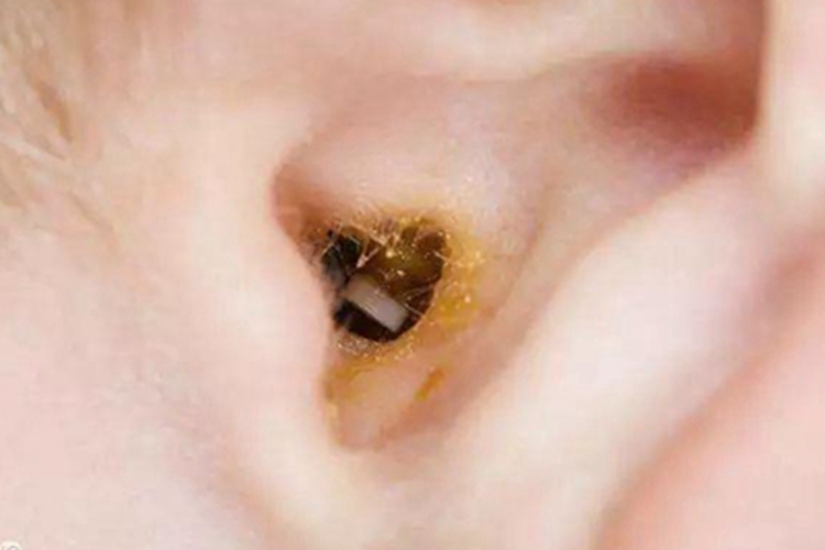 外耳湿疹耳朵眼有黄水结痂图