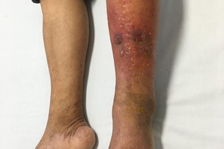 皮肤丝虫病水疱图