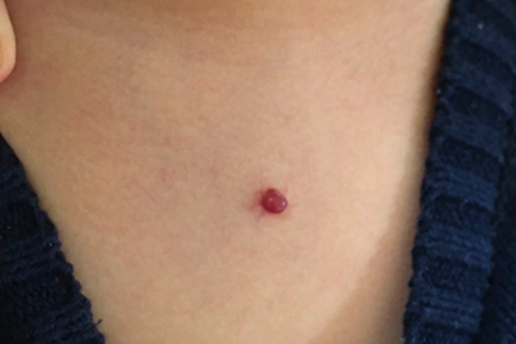 化脓性肉芽肿前颈血丝图