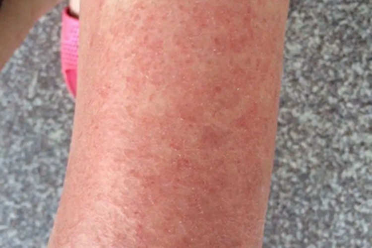 慢性接触性皮炎胳膊红斑图