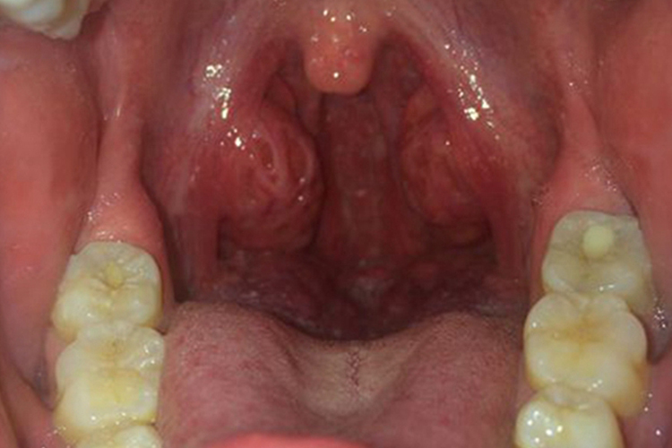 慢性扁桃体炎图 慢性扁桃体炎图