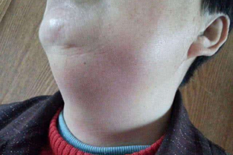 费尔蒂综合征淋巴结肿大症状图 费尔蒂综合征淋巴结肿大症状图