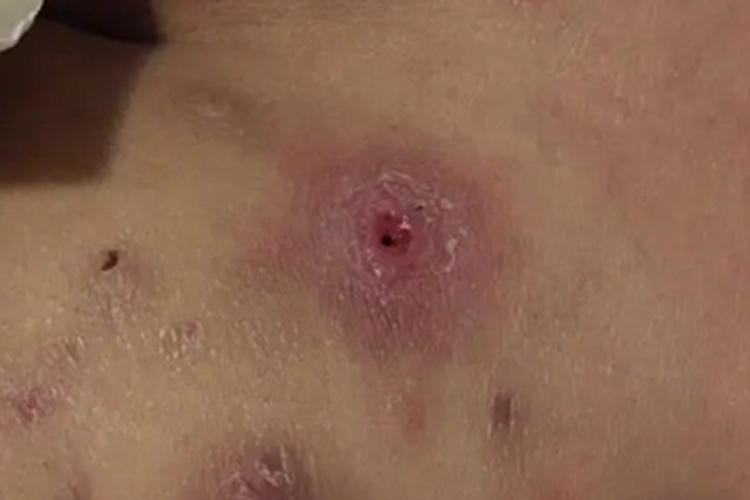 热带痤疮臀部脱皮图