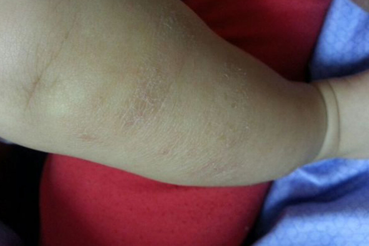 肥胖型黑棘皮病图