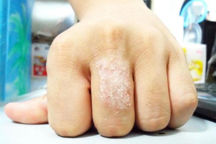 儿童干性湿疹苔藓样斑块图