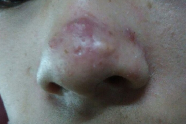 酒糟鼻鼻部脓包图