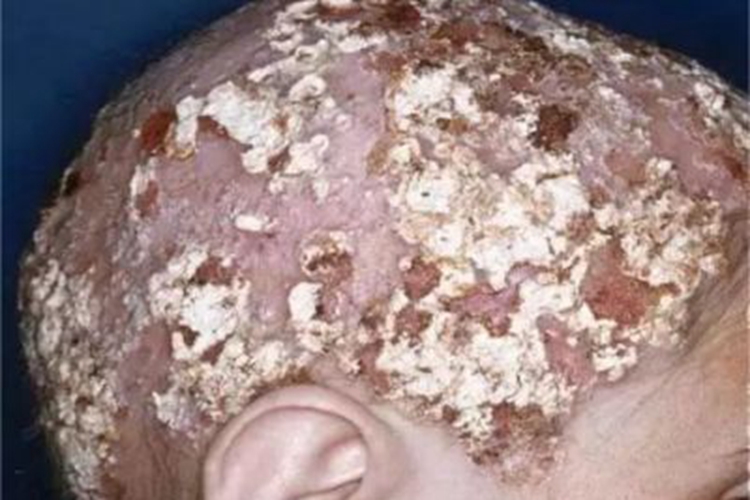 头癣头皮结痂图