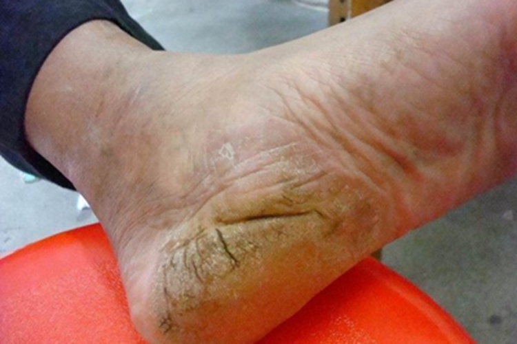 皲裂性湿疹脚后跟裂纹图