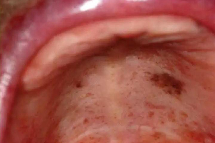 色素沉着息肉综合征图 色素沉着息肉综合征图