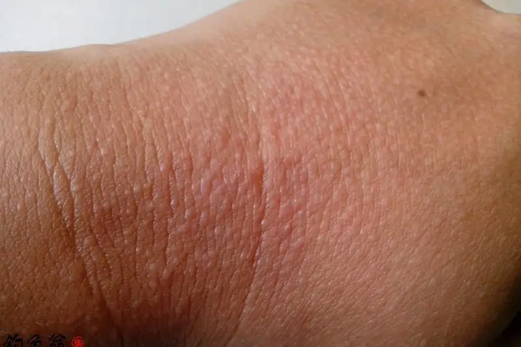 轻微紫外线过敏图