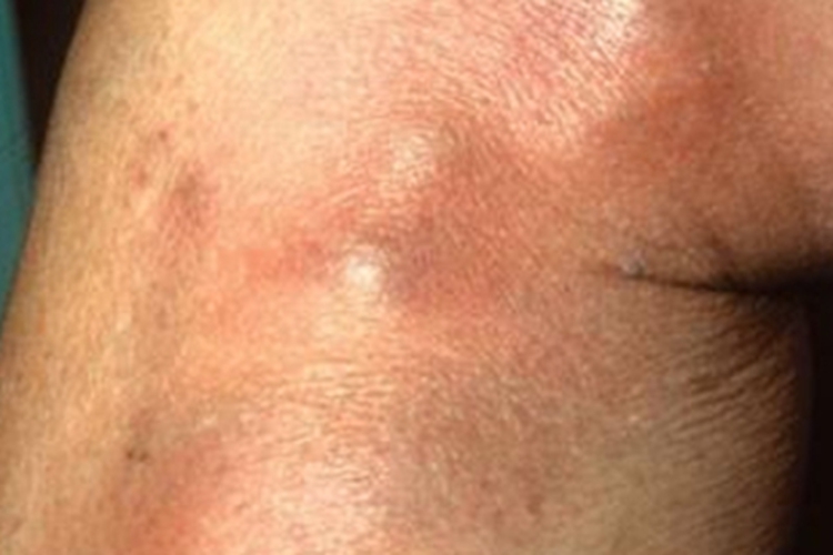 游走性血栓性静脉炎腿上长结节图 游走性血栓性静脉炎腿上长结节图