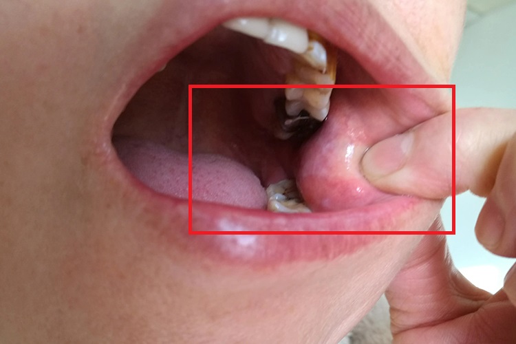 口腔粘膜上白色颗粒图片