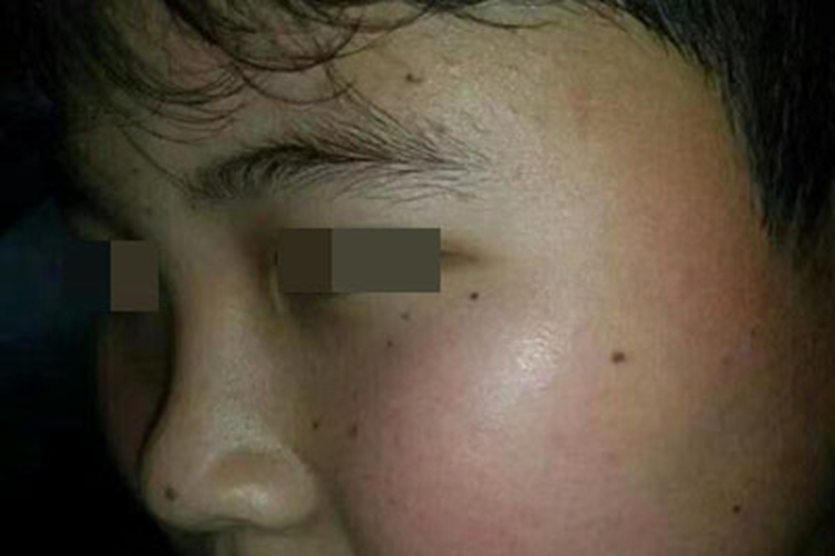 交界痣面部有很多黑痣图