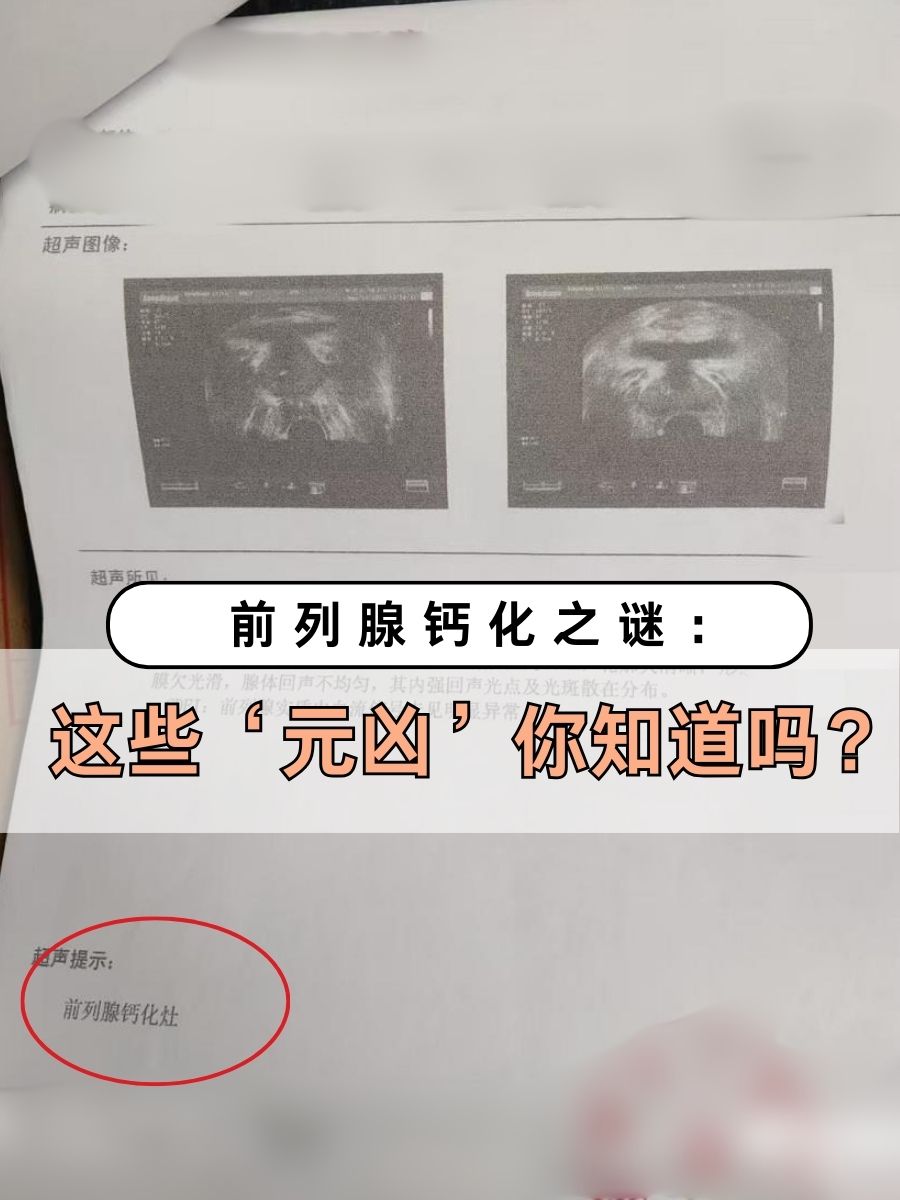 前列腺钙化之谜：这些‘元凶’你知道吗？