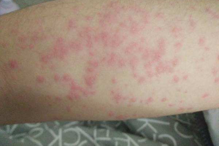 湿疹小腿起一堆小红点图