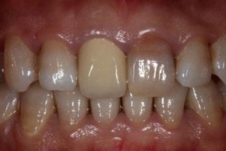 死髓牙牙齿无光泽图