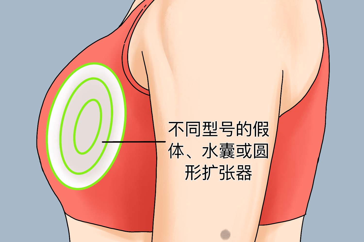 乳房假体隆乳术测量方法图