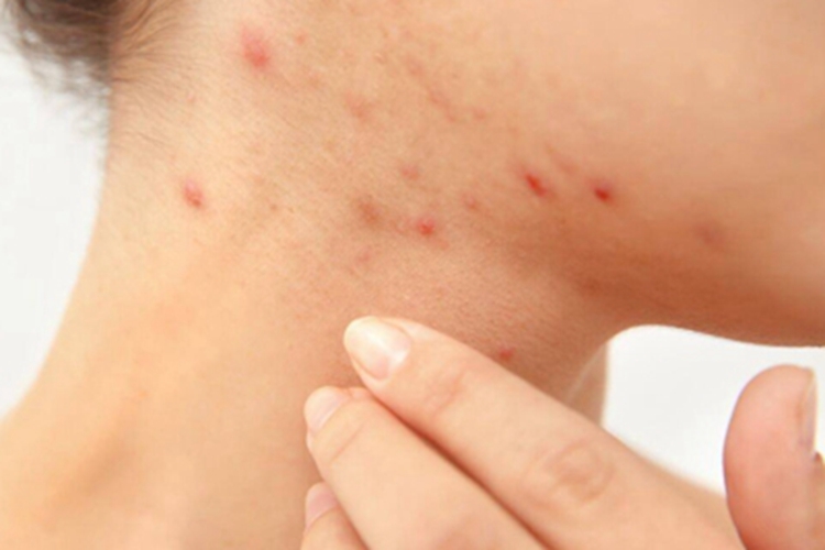 三期梅毒颈部丘疹图