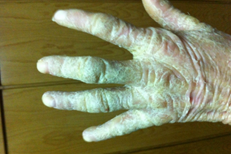 鱼鳞病手部皮肤增厚图 鱼鳞病手部皮肤增厚图